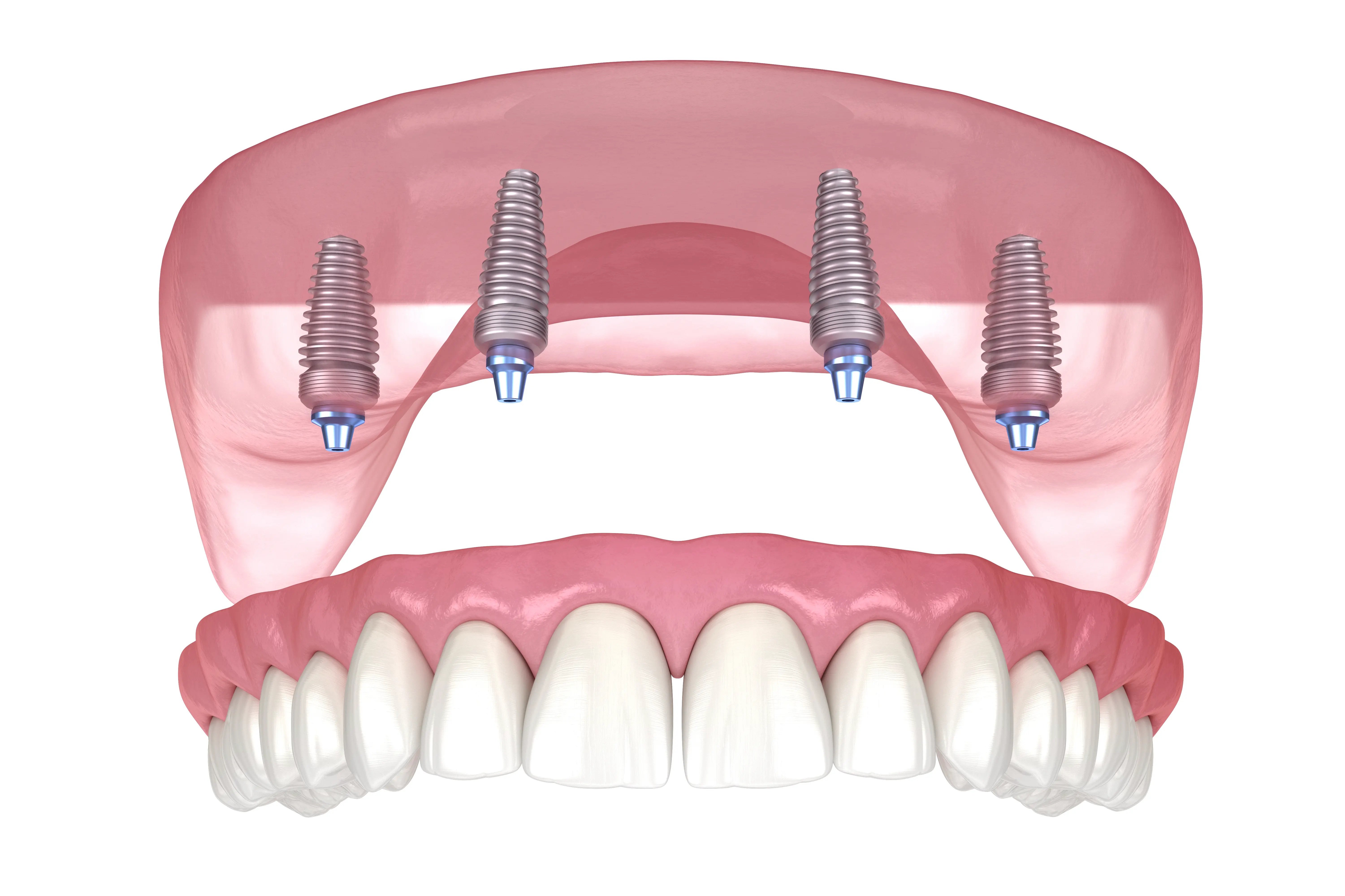 All-on-4 dental implant consultation at Serenity Dental of Bloomingdale — Dr. Husna Khan plans full arch replacement with four implants and a same-day fixed bridge using CBCT imaging