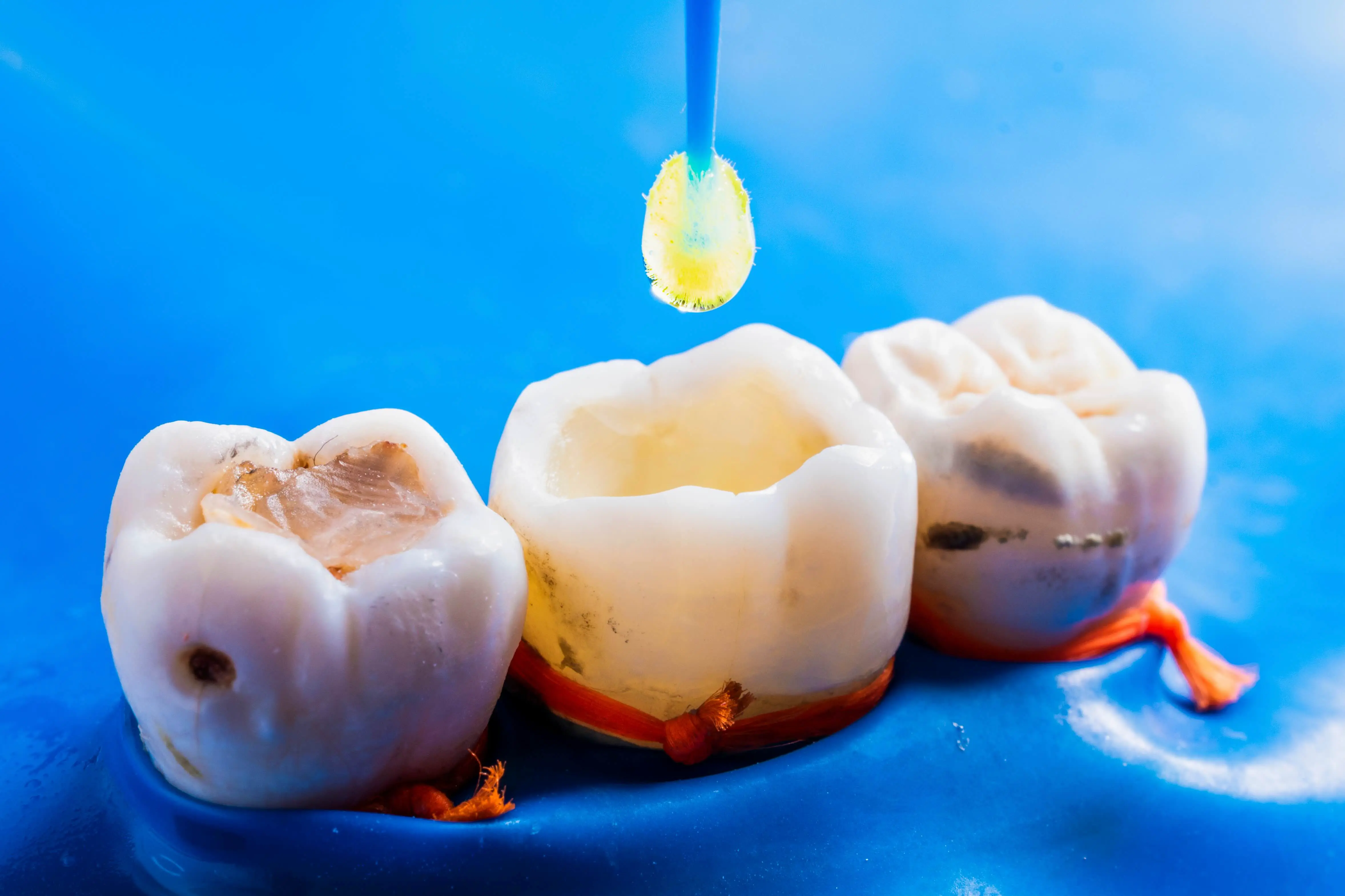 What is dental bonding consultation at Serenity Dental of Bloomingdale -- Dr. Husna Khan explains the procedure including composite resin material, etching and bonding agent steps, layered curing, and final polishing for a single visit cosmetic or restorative repair