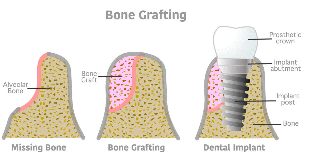 Granular dental bone graft material in a sterile container alongside vials of saline at a Serenity Dental of Bloomingdale operatory, with the bovine xenograft, allograft, and synthetic alloplast options shown side by side