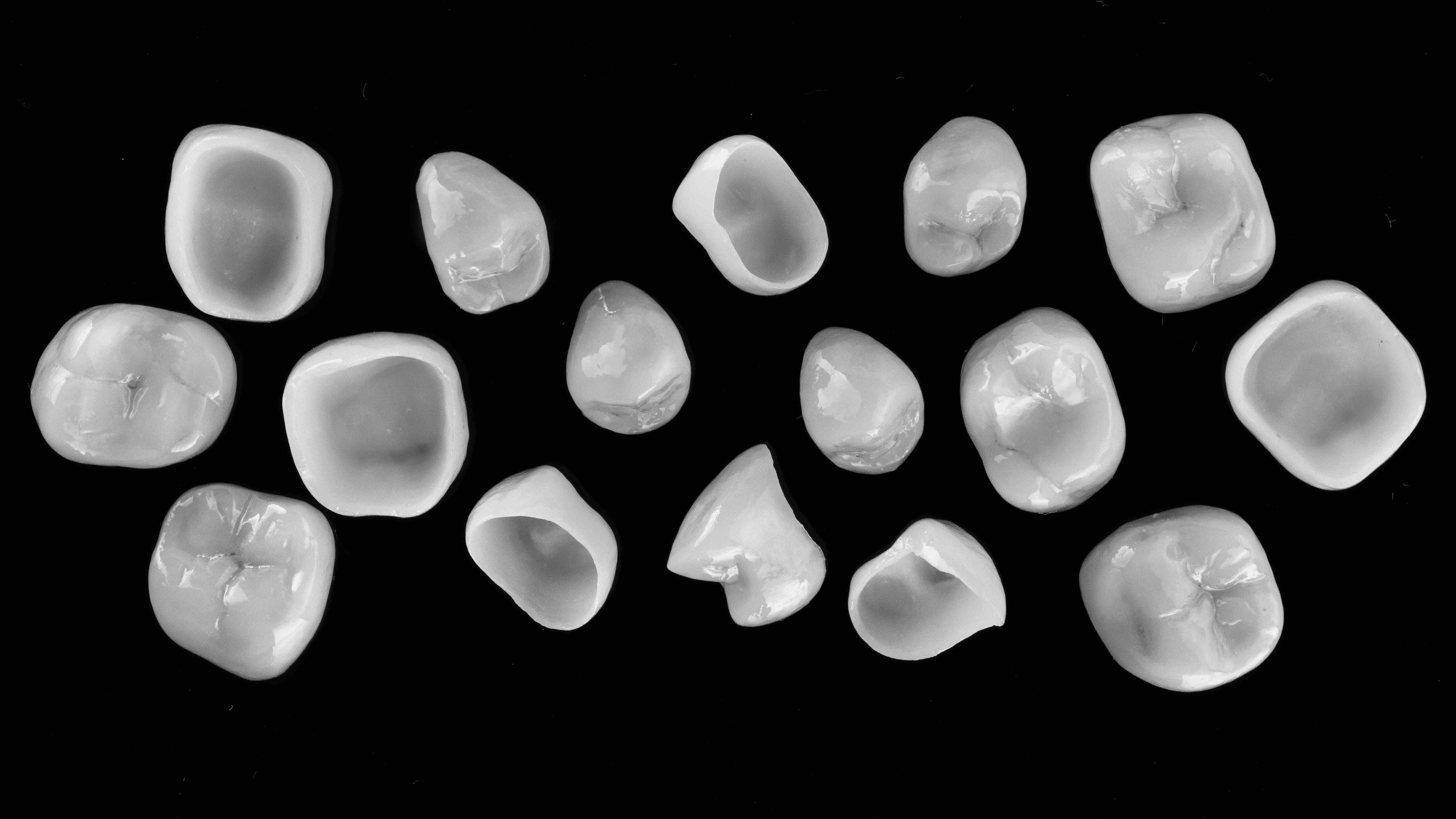 Close-up of a natural-looking dental crown