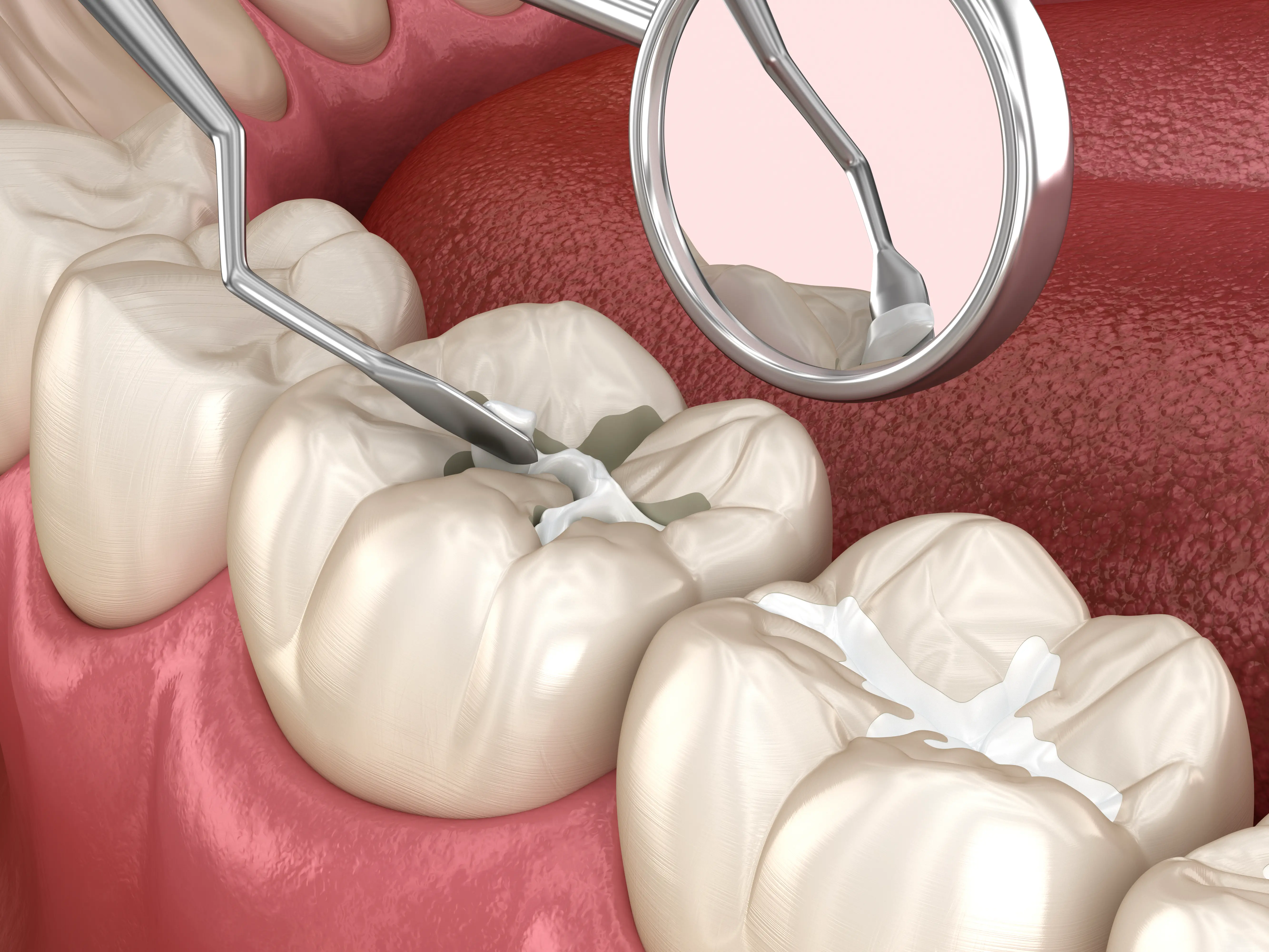 Dental treatment at Serenity Dental of Bloomingdale — sealants protect the chewing surfaces of molars with a thin bonded coating that prevents bacteria from reaching the grooves where most cavities start