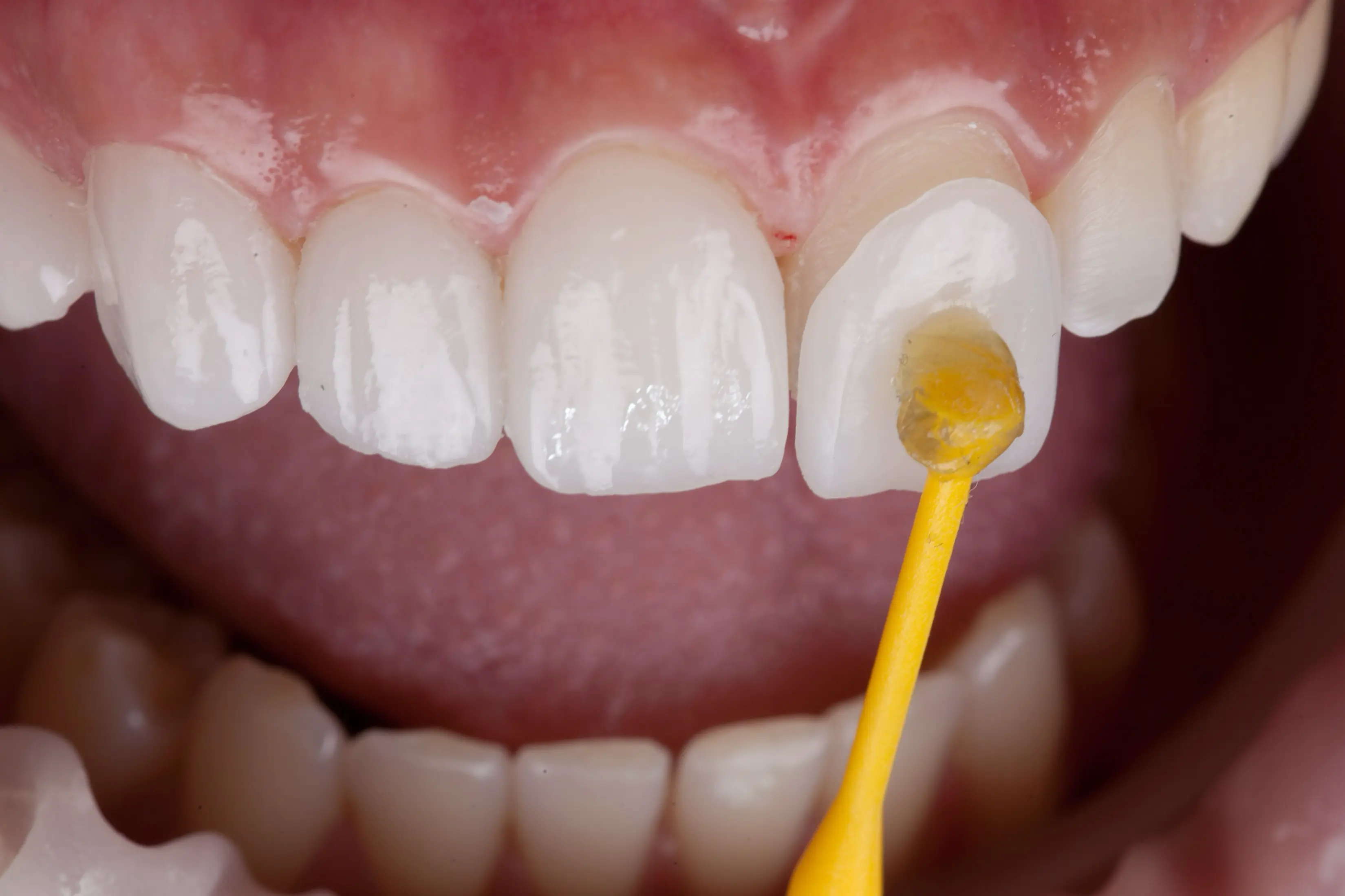 What Are Dental Veneers? How They Work and What They Fix