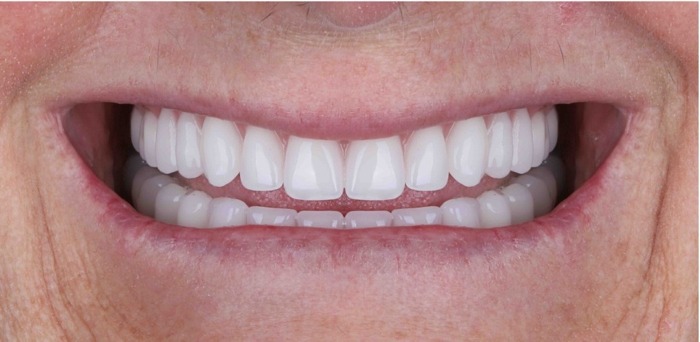 Before and after comparison