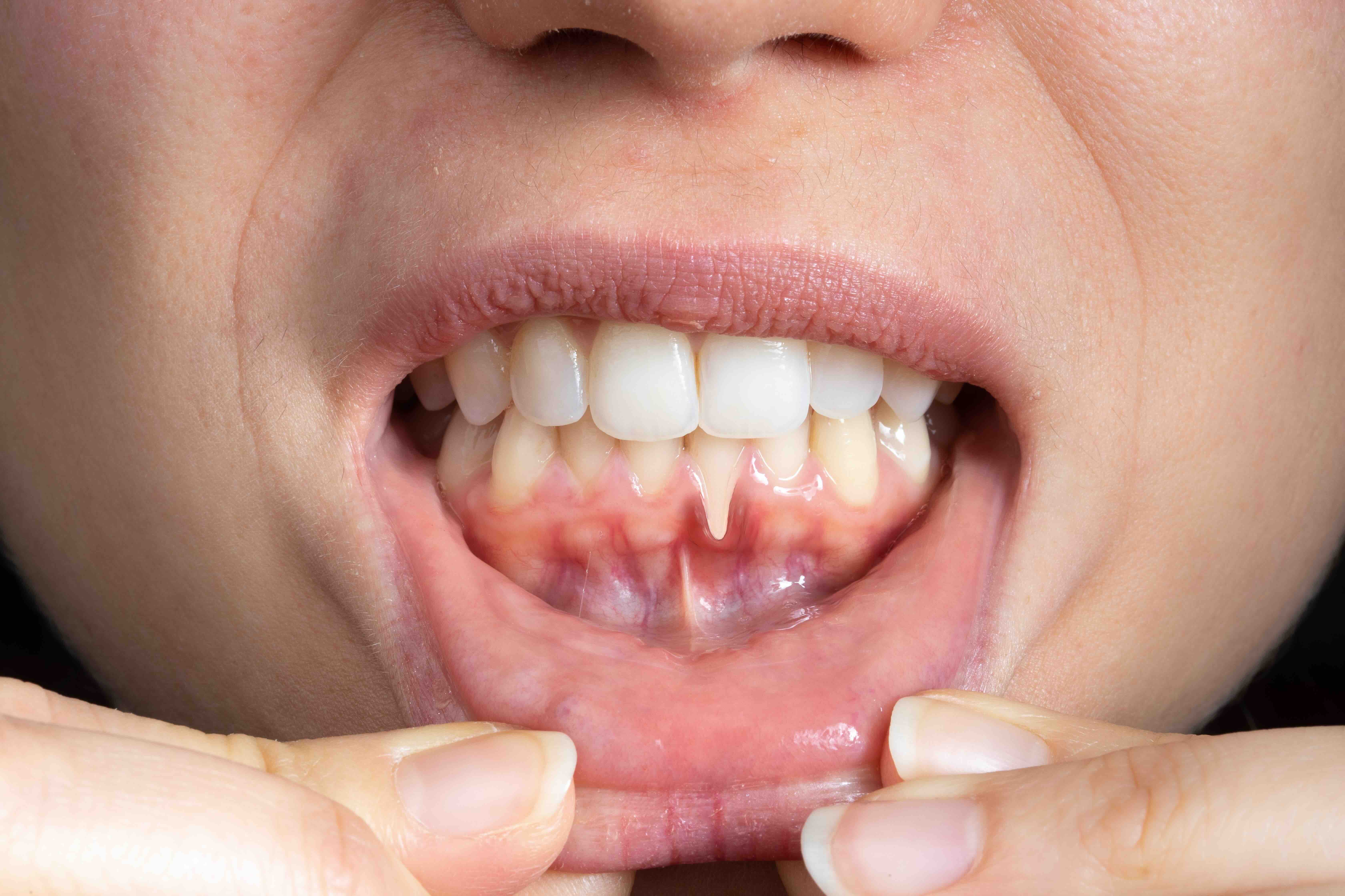 Healthy gums after periodontal treatment