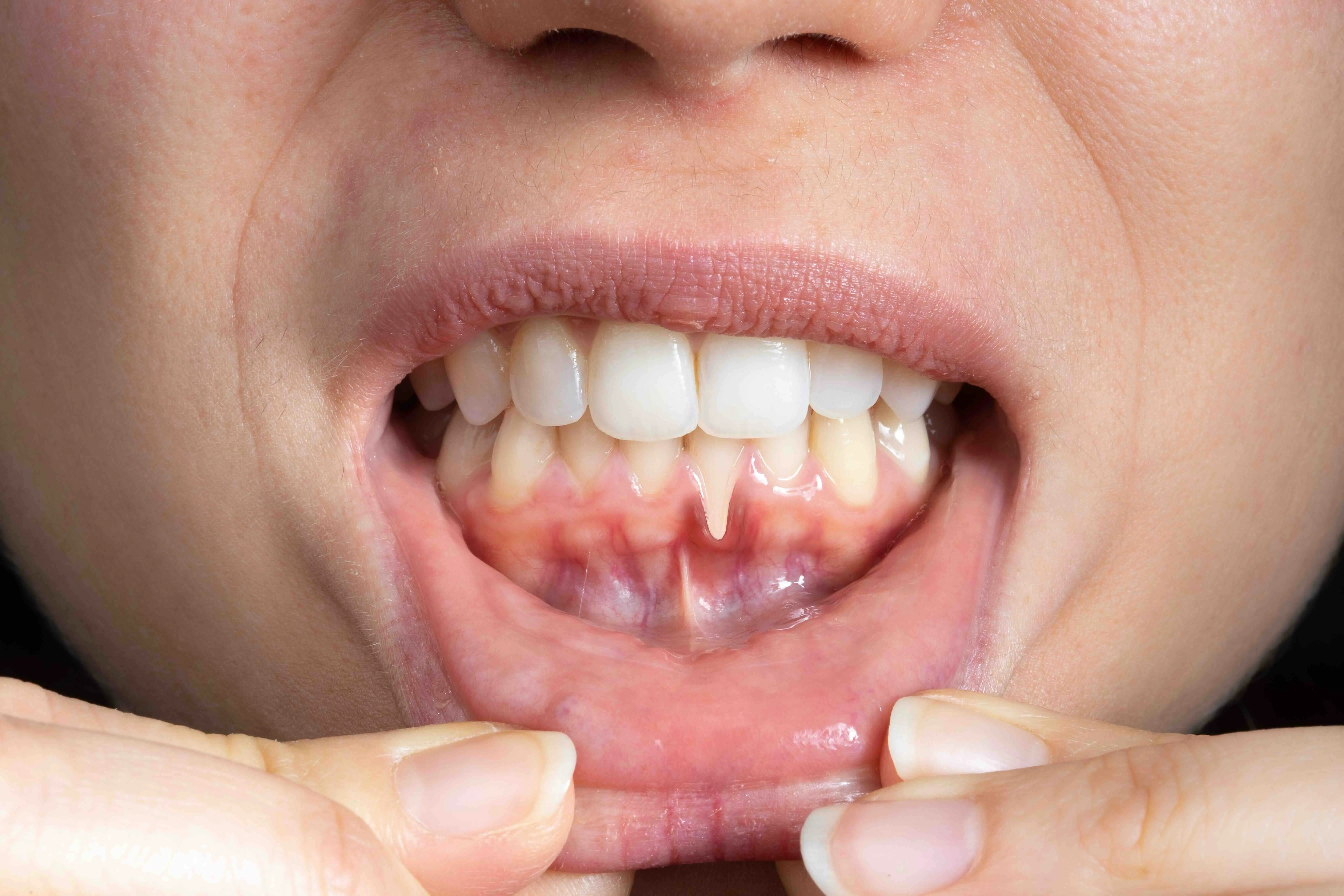 Healthy gums after periodontal treatment at Serenity Dental of Bloomingdale