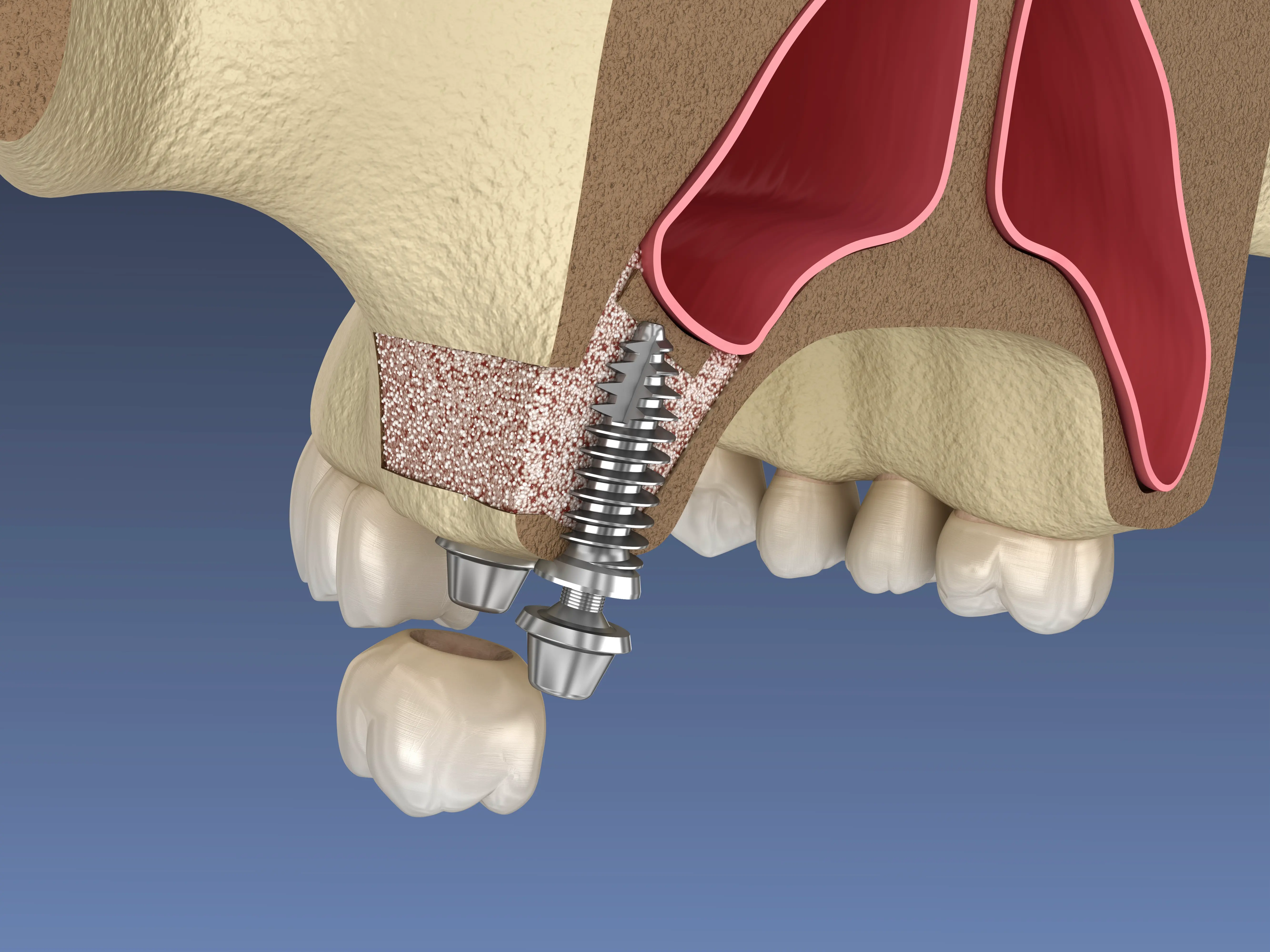 Sinus lift consultation at Serenity Dental of Bloomingdale — Dr. Husna Khan reviews CBCT imaging to plan sinus augmentation for dental implant placement
