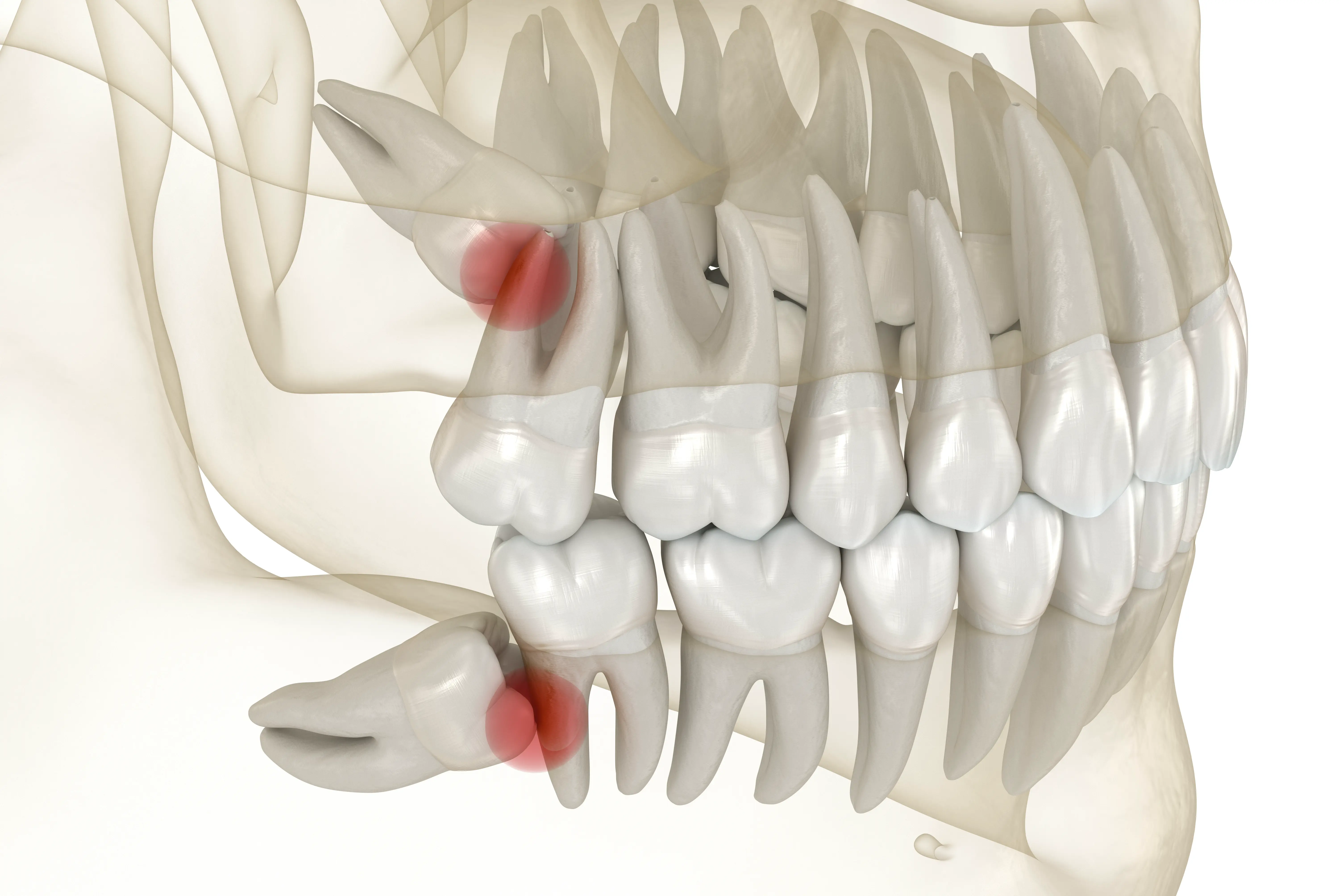 Wisdom teeth removal consultation at Serenity Dental of Bloomingdale -- Dr. Husna Khan evaluates impaction type and recommends whether wisdom tooth removal is necessary based on X-ray findings